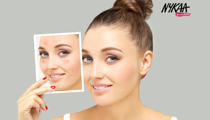 BEST ACNE SCAR REMOVAL TREATMENTS BY DR. DEEPALI BHARADWAJ
