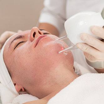 best acne treatments- laser