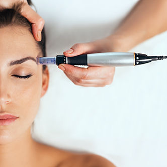 best acne treatments- micro needling