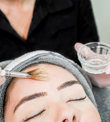 treatment for pimples on face- chemical peels