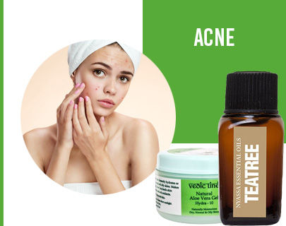 Summer Skin Care Tips- Acne