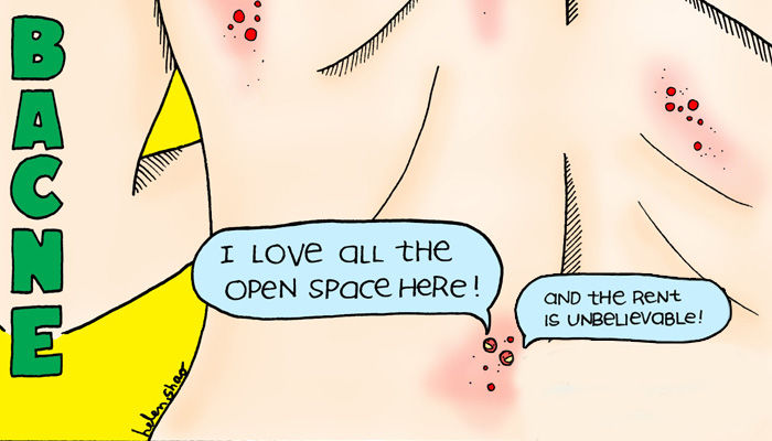 Back Acne Causes and Cure