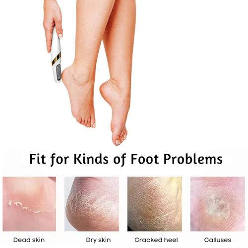 Buy Signaxo PediCare Callus Remover With Roller Heads Foot