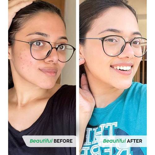 plix glutathione review before and after Buy Hyaluronic Acid Effervescent Tablets For Skin Hydration Reduce Fine Lines basta anti age serum Size:50mg x 90 Latest Information About Protein