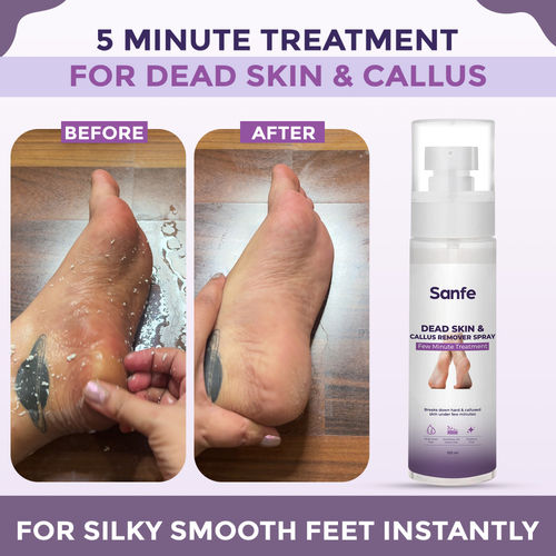Buy Sanfe Dead Skin Callus Remover Spray Freshens, Exfoliates
