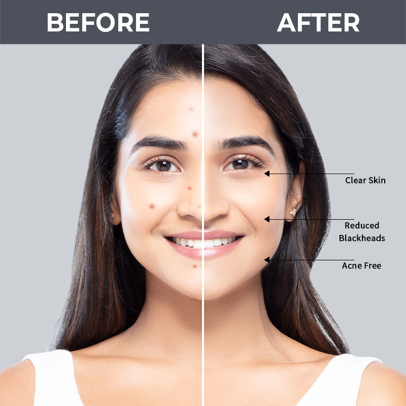 Buy Nykaa SKINRX 2 Salicylic Acid Face Serum For Acne, Blackheads