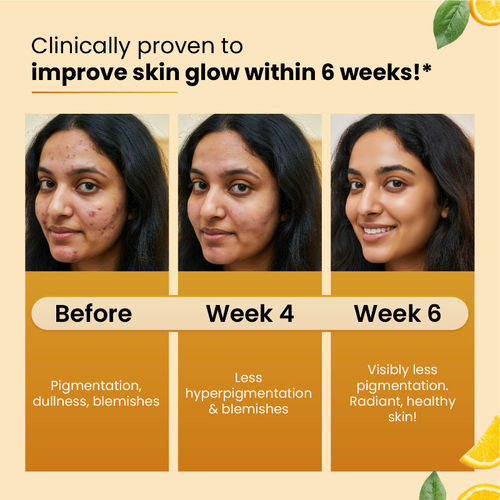 glutathione tablets for hyperpigmentation Glutathione as a skin‐lightening agent and in melasma: a systematic review  - Sarkar - 2025 - International Journal of Dermatology main image 1