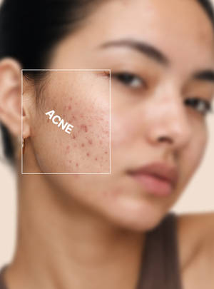 Acne