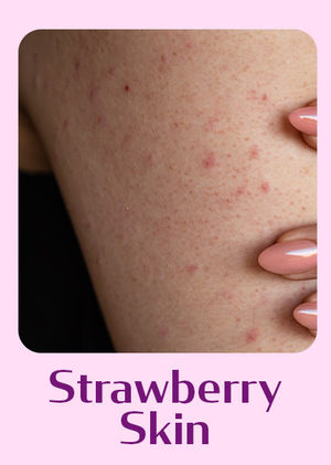 Strawberry Skin