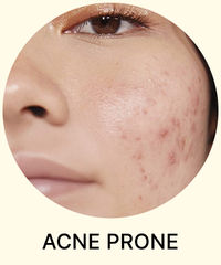 Acne Prone