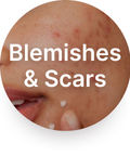 Blemishes & Scars