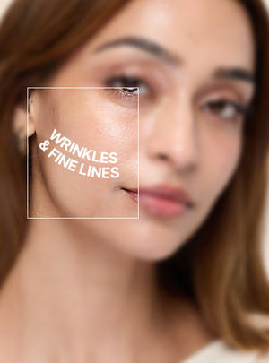 Fine Lines & Wrinkles