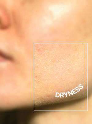 Dryness