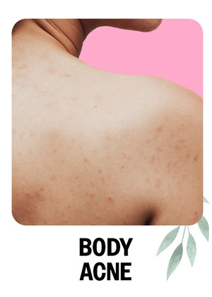 Body Acne