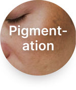 Dark Spots Pigmentation