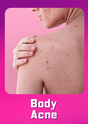 Body Acne