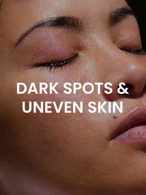 Dark Spots and Uneven Skin