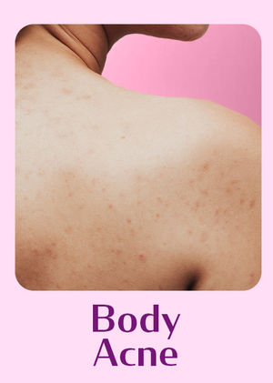 Body Acne