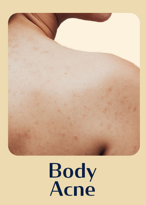 Body Acne