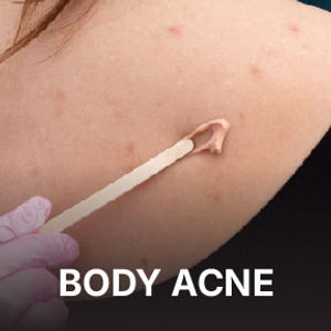 Body Acne