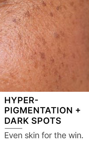 Hyperpigmentation