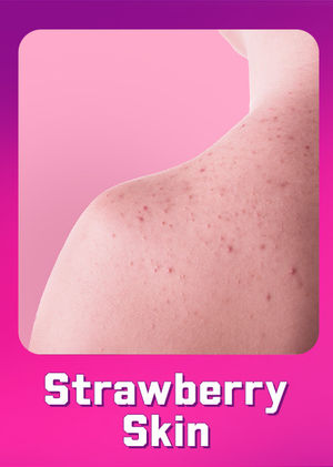 Strawberry Skin