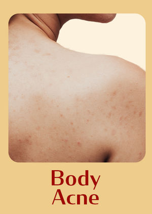 Body Acne