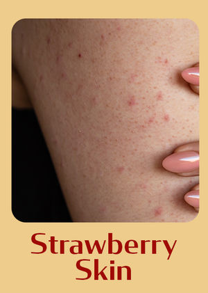 Strawberry Skin