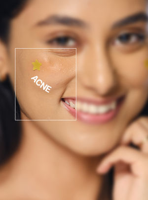 Acne